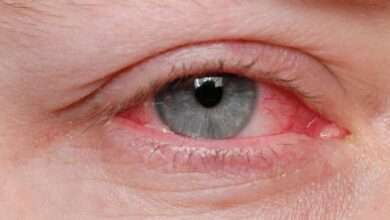 Can you get pink eye from a fart