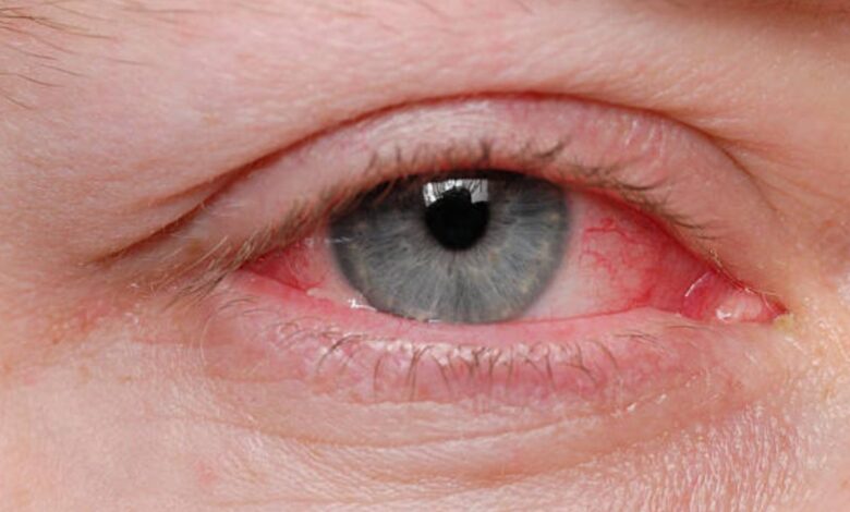 Can you get pink eye from a fart